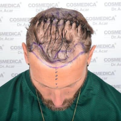 Liam McAleese vor der Haartransplantation