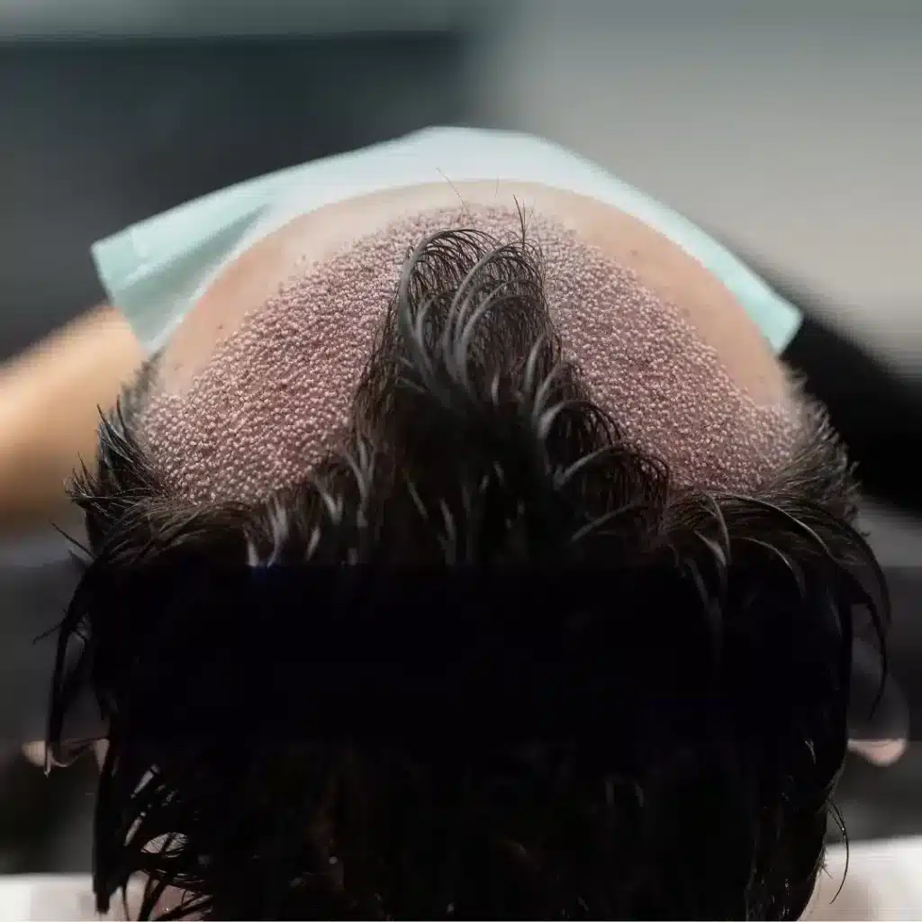 Was wird mit einer Haartransplantation erreicht?