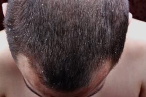 Man with dandruff suffering from hair loss