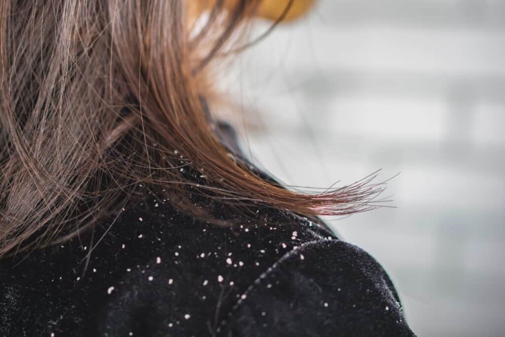 Woman with dandruff