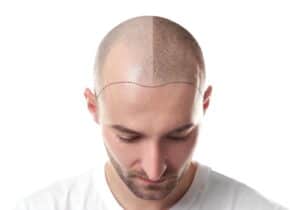 do hair transplant work