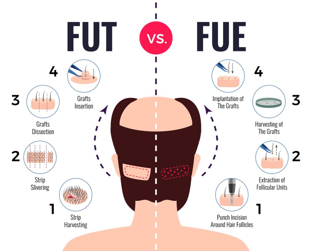 Illustration of how FUT and FUE hair transplant work