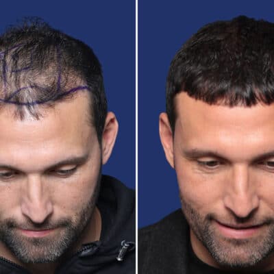 Kevin Kuranyi - Hair Transplantation Before and After