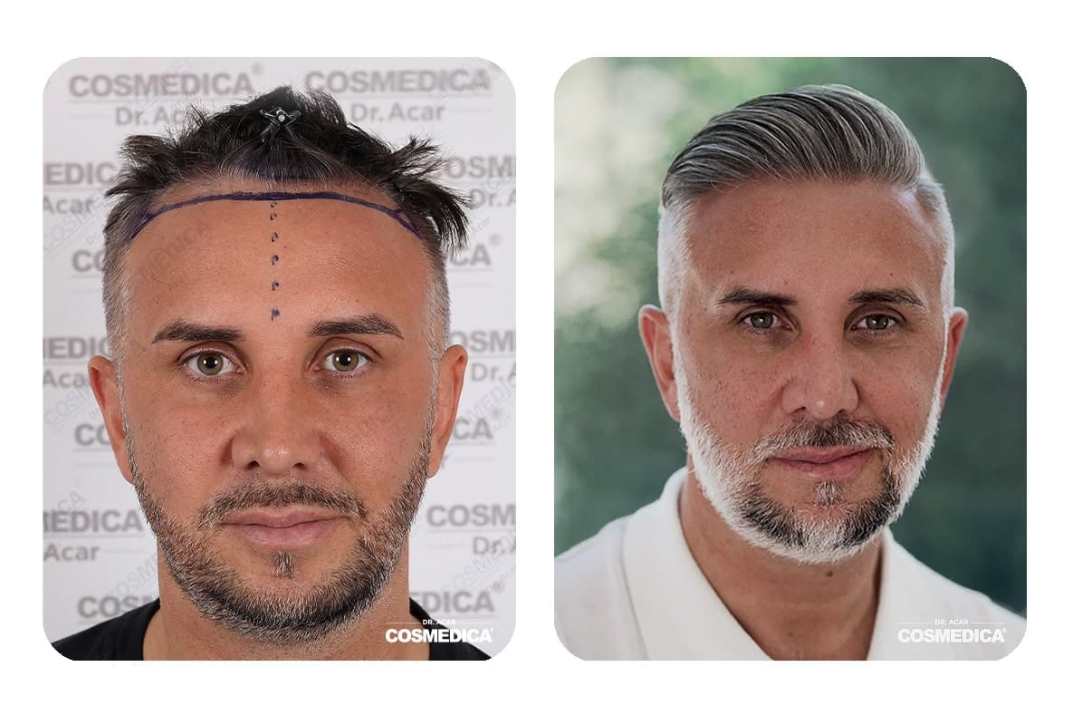 Image of Keiran Lee before and after hair transplant result