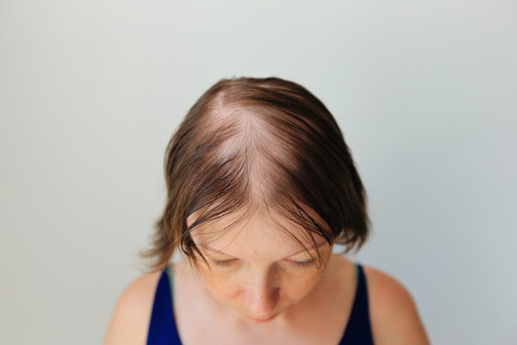 transplante capilar feminino alopecia androgenética​