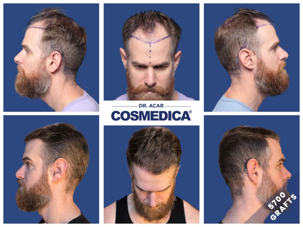 Photos avant-après de cheveux qui repoussent suite à une greffe de cheveux en Turquie chez Cosmedica Clinic