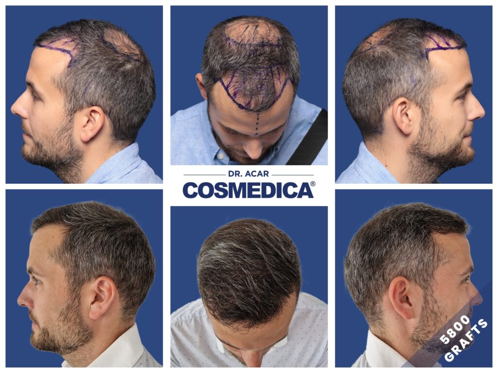 Before and after result of a crown hair transplant