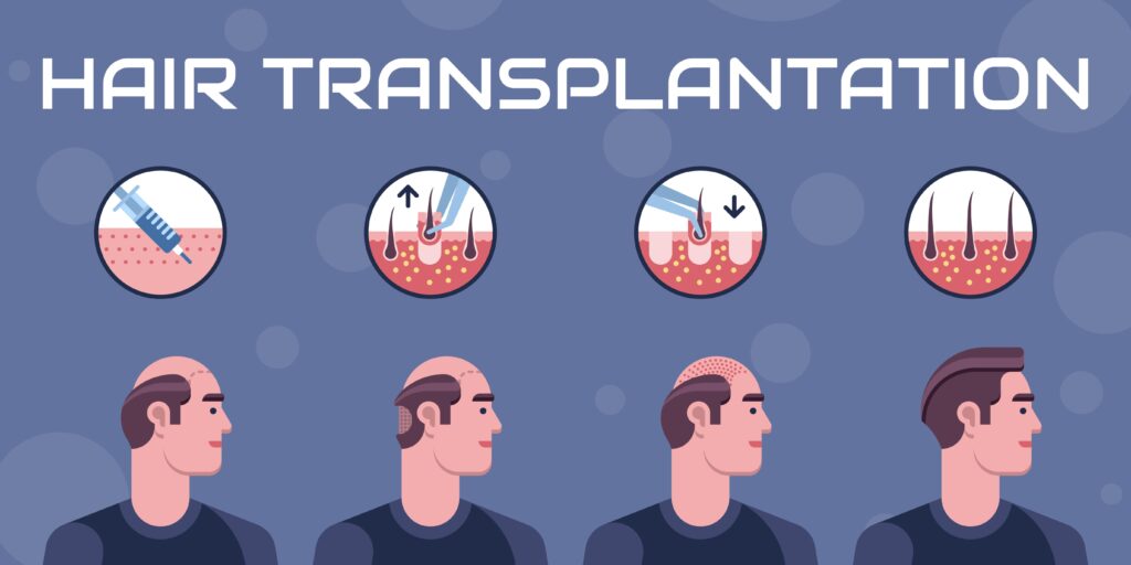 Hair transplant process