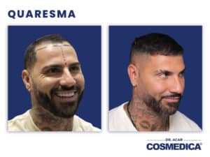 Quaresma Haartransplantation vorher nachher