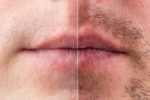 Mustache transplant