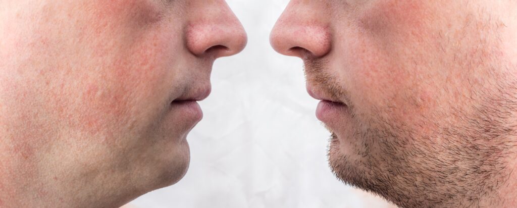 Beard and mustache transplant before and after