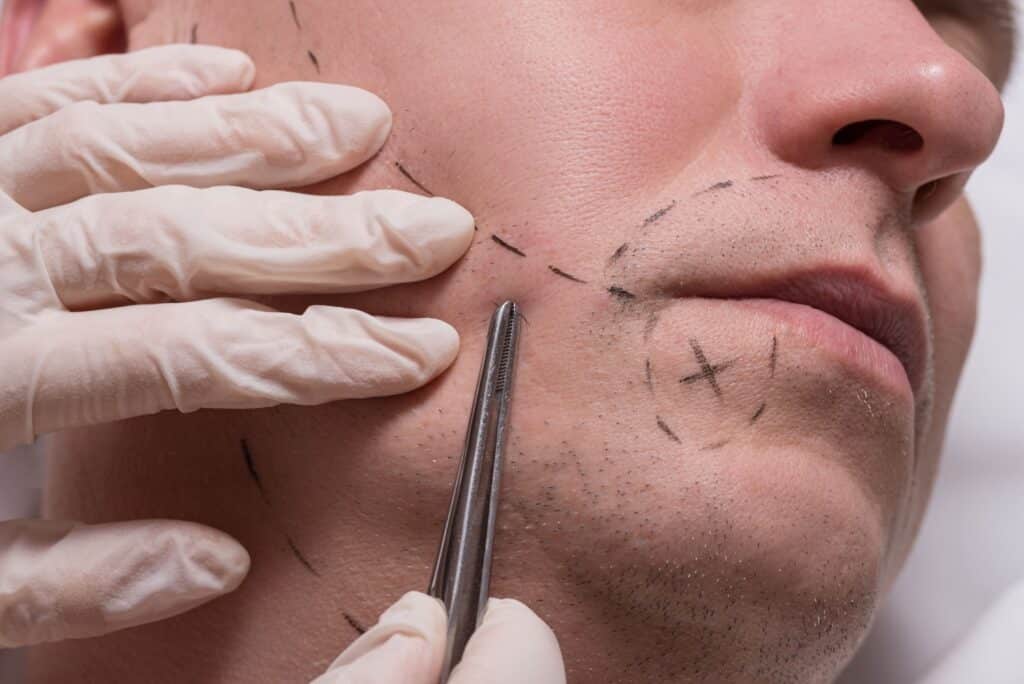 Beard and mustache transplant consultation