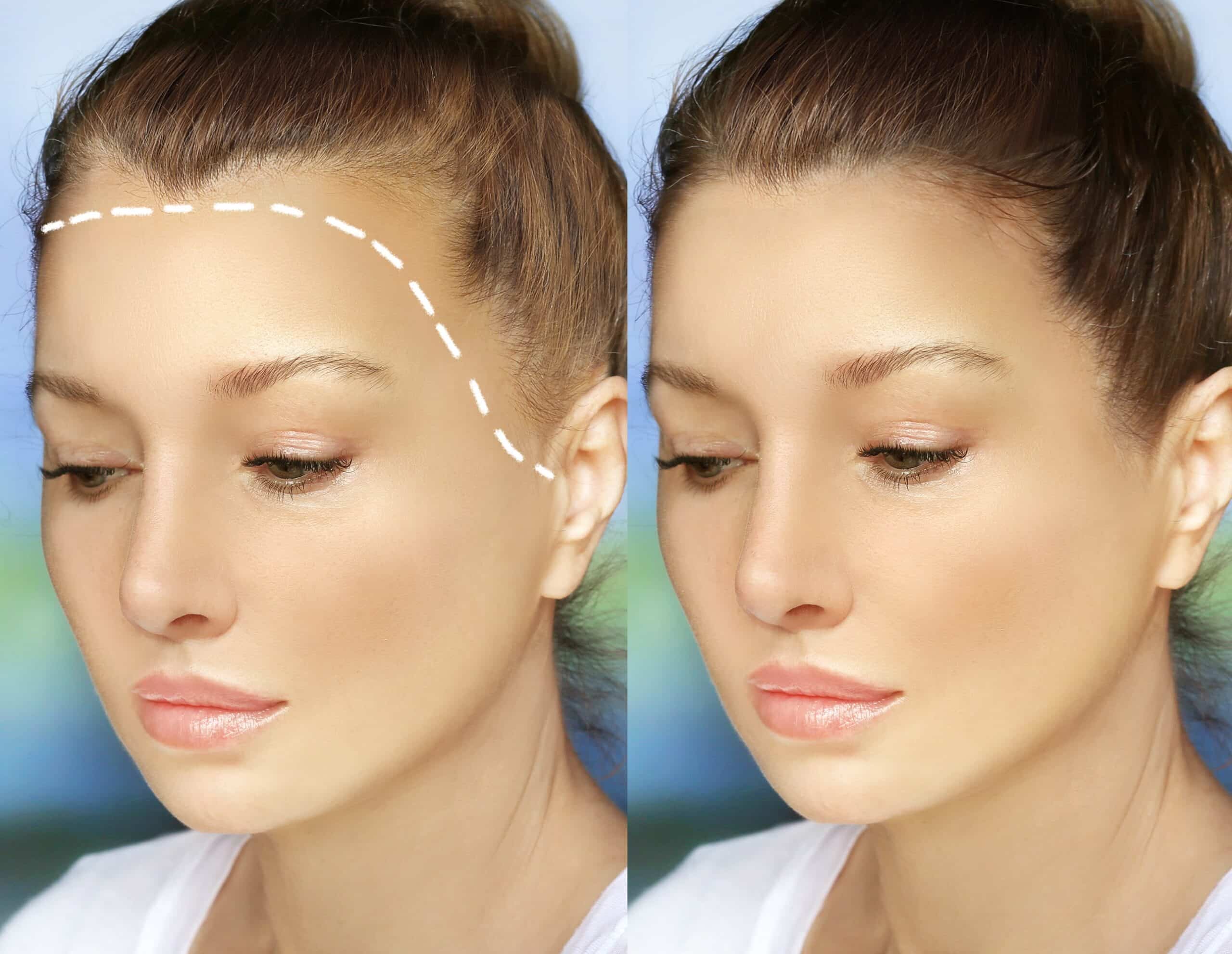 frontale fibroserende alopecia
