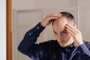 Imagen de un hombre con injerto capilar mal hecho