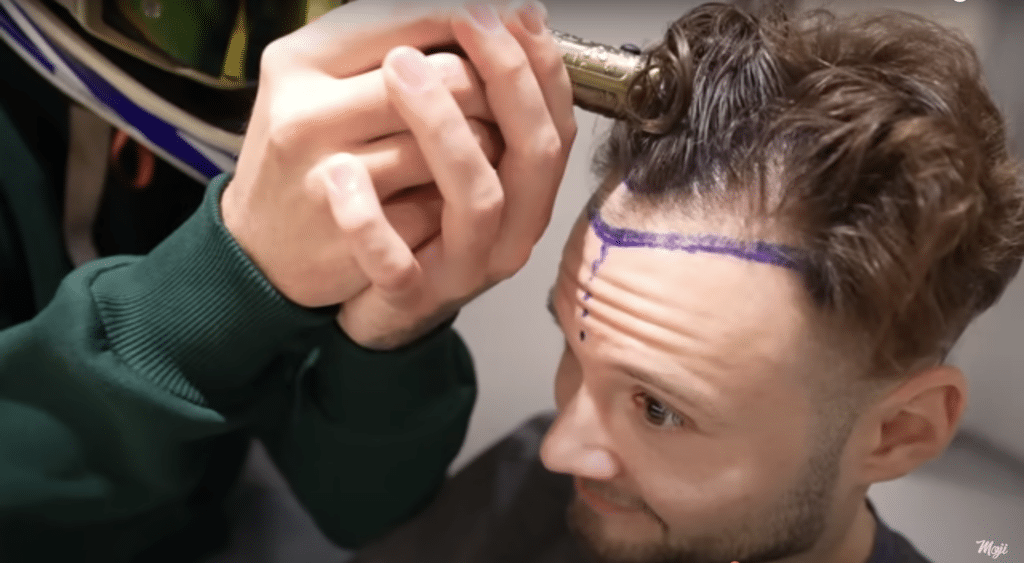 Inscope21 vor der Haartransplantation