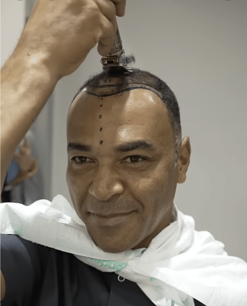 Captain Cafu Haartransplantation in der Türkei