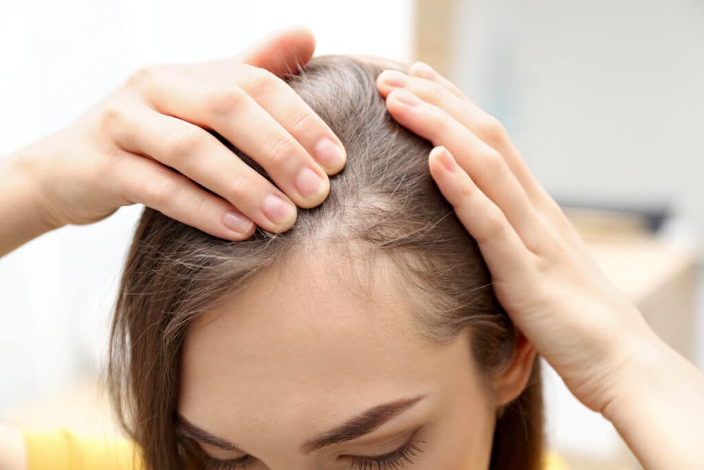 Haartransplantation bei Cosmedica: Die dauerhafte Lösung gegen Haarausfall bei Frauen