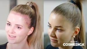 Haarausfall bei Frauen: Ursachen, Symptome und Maßnahmen