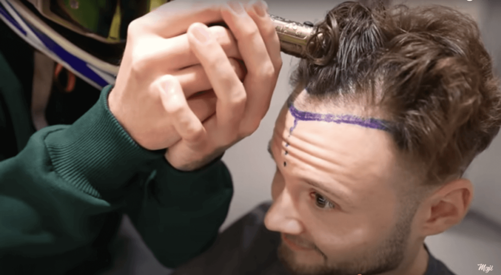 Inscope21 vor der Haartransplantation