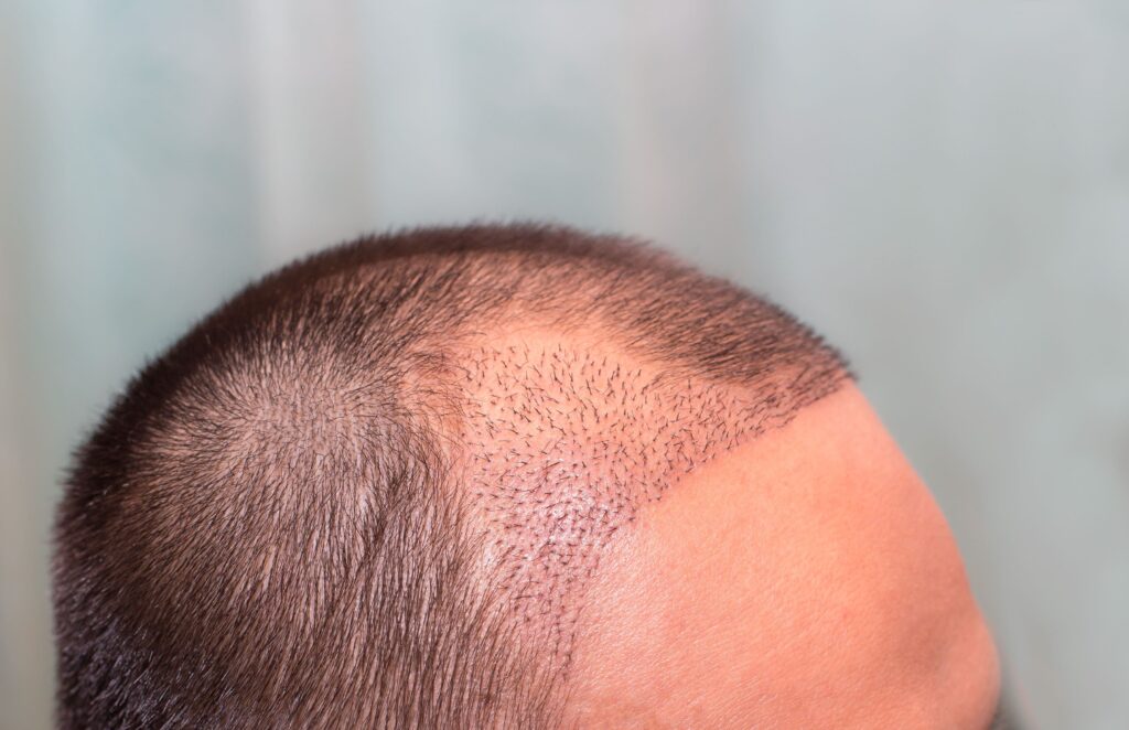 Man's head after a hair transplant