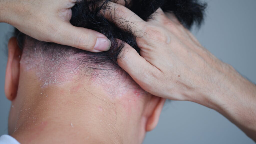 Cou d'un homme atteint de dermatite séborrhéique