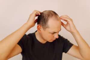 photo d'homme avec dermatite séborrhéique et perte de cheveux