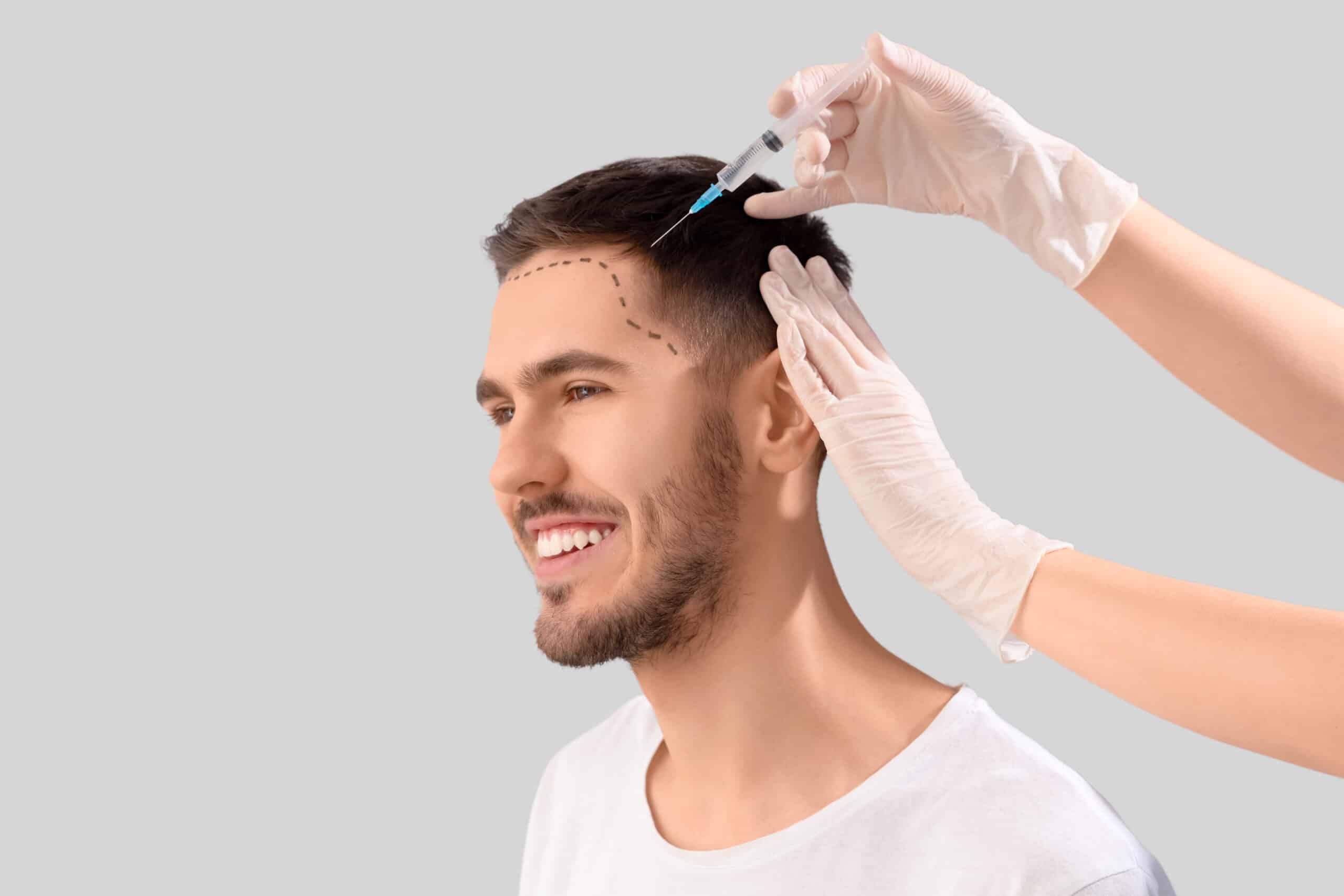 Hombre feliz porque eligió hacerse el microinjerto capilar