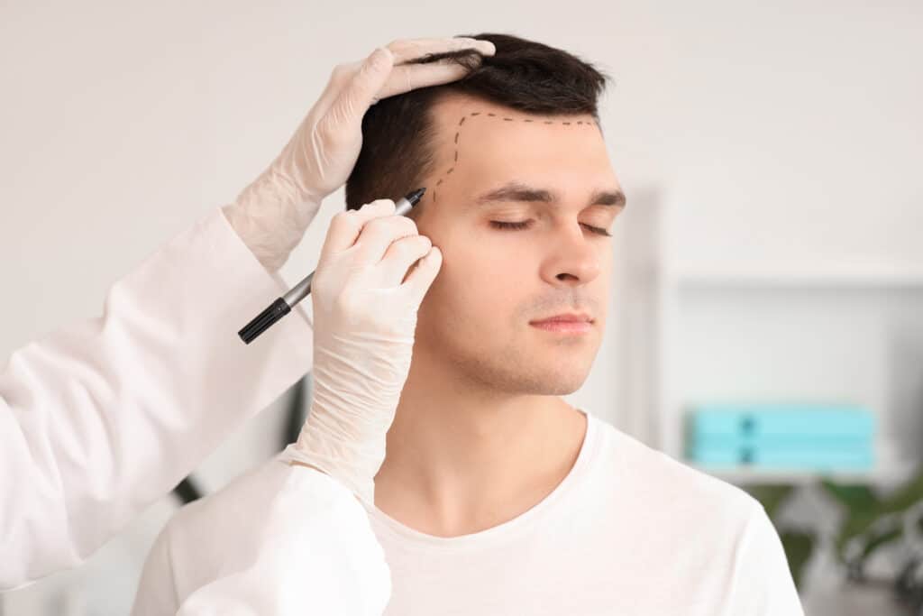 Un médico marca la cabeza de un joven con problemas de caída del cabello