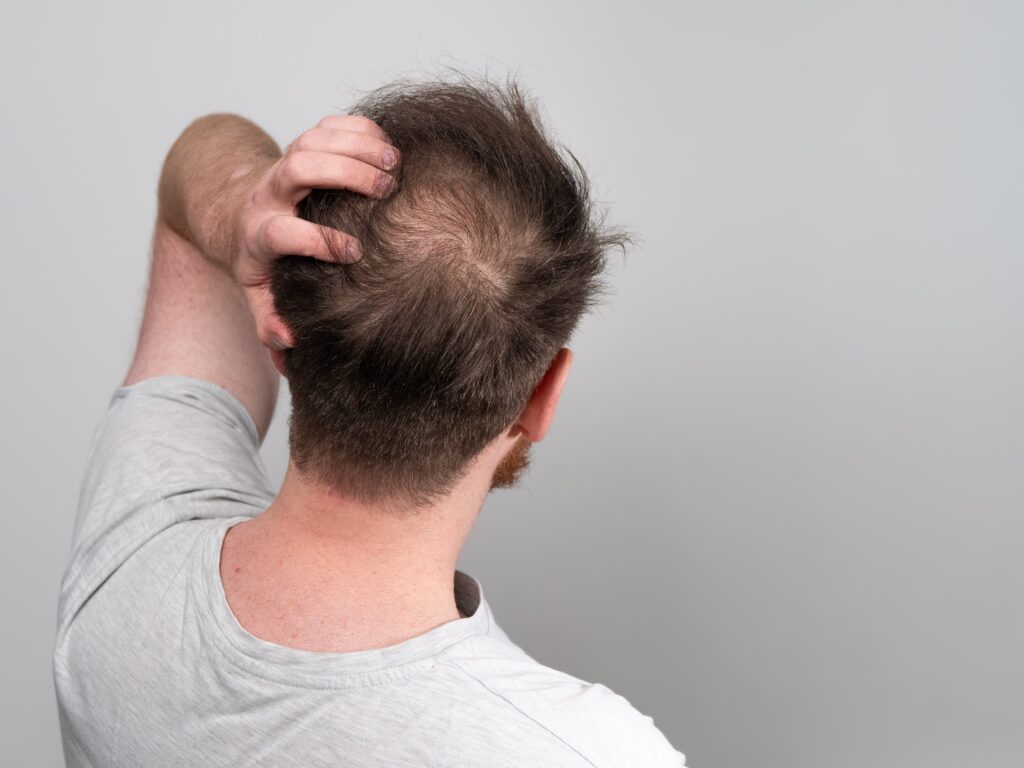qual a quantidade normal de- queda de cabelo