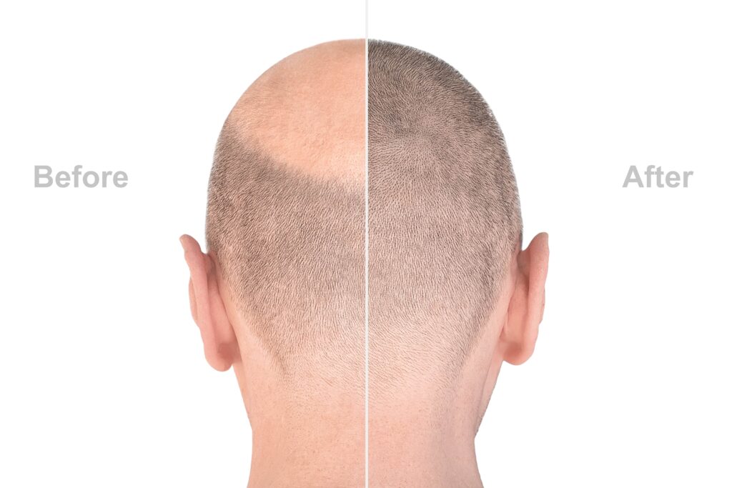 Herstel en haargroei zichtbaar op achterhoofd na haarimplantatie