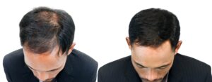 Avancée de la médecine capillaire grâce aux nouvelles technologies de régénération, dont le clonage des cheveux