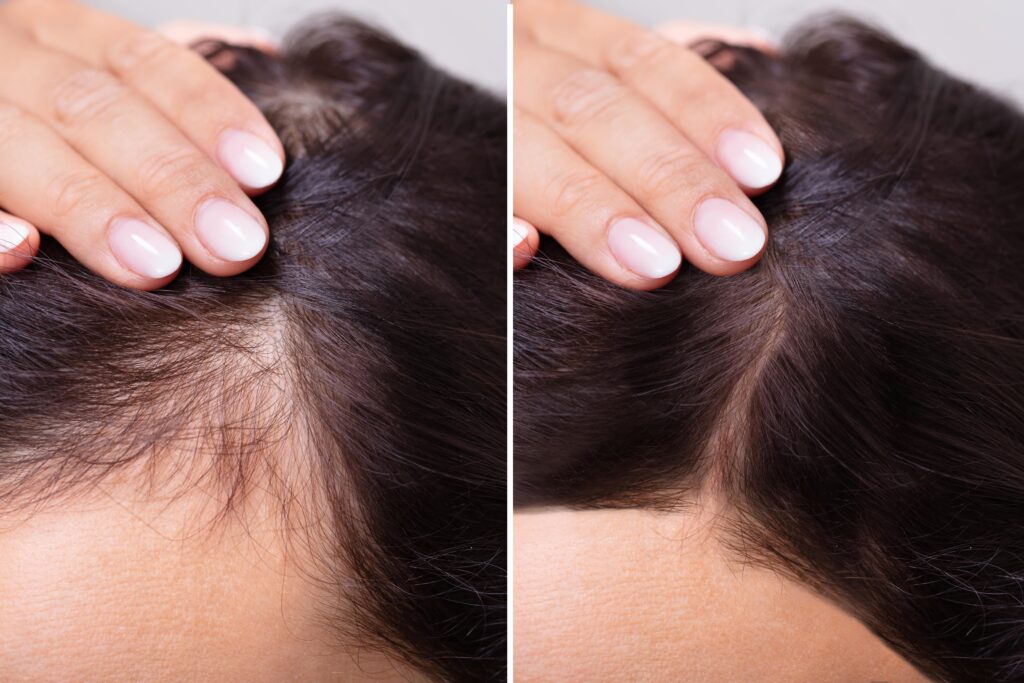 Comparaison avant/après montrant la densité de cheveux retrouvée après traitement