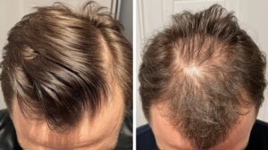Voor en na resultaat van een succesvolle haartransplantatie bij man