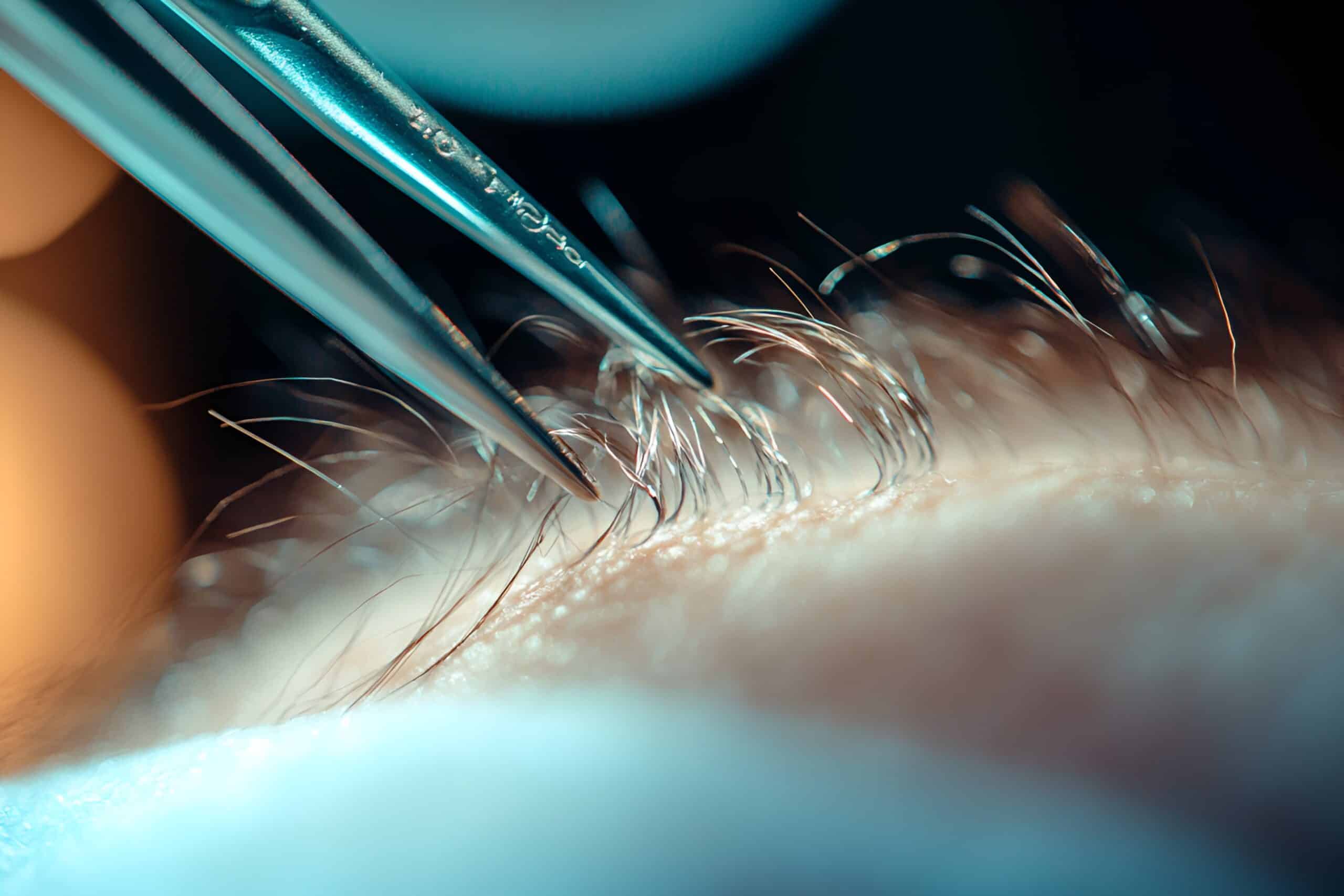 Photo of a close-up hair transplant procedure showing forceps implanting individual grafts into the scalp