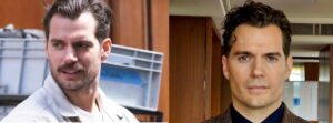 Henry Cavill before and after hair transplant comparison