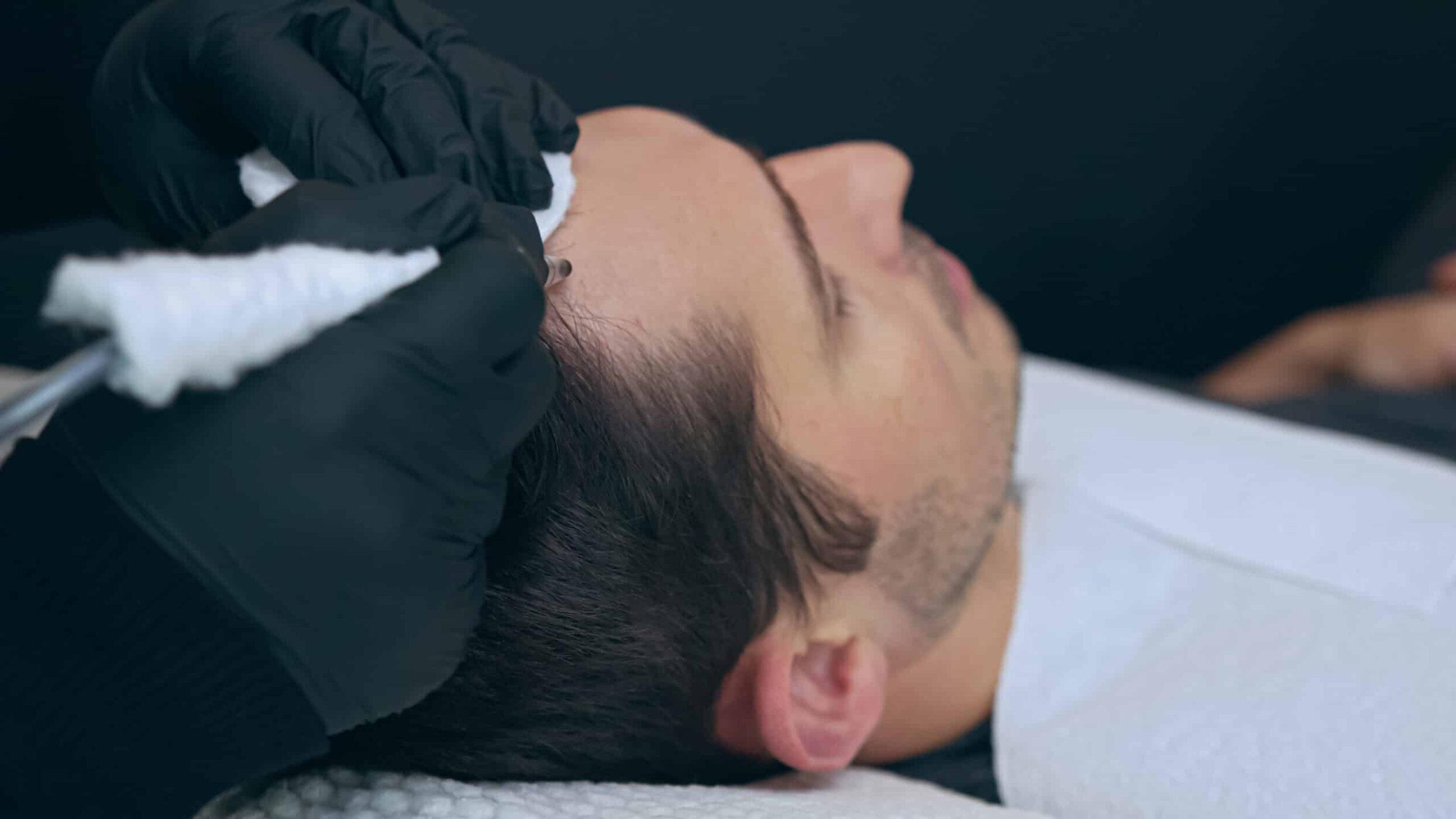 Hombre sometido a una operación de micropigmentación capilar