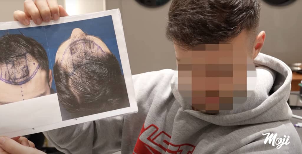 Mojis Gesicht: Vorher-Nacher Haartransplantation