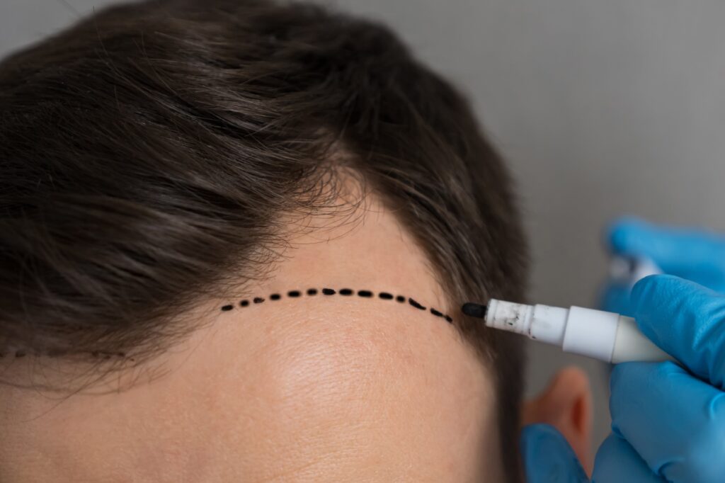 Photo of a dotted line on a patient's forehead to mark the new hairline before transplant surgery