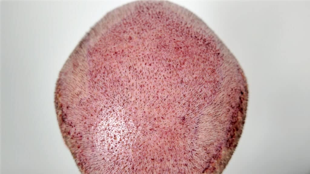 Cuir chevelu avec micro-croûtes après greffe de cheveux FUE, cicatrisation post-opératoire