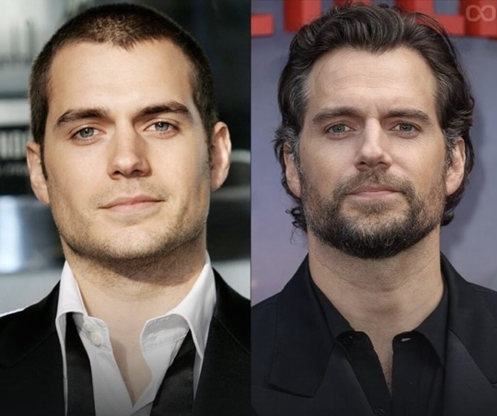 photo of Henry Cavill before and after hair transplant