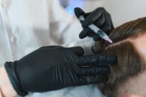 photo d'une séance de mésothérapie pour cheveux