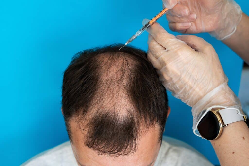 Photo d'un homme subissant une séance de mésothérapie pour cheveux
