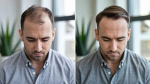 Before and after comparison of a young man showing successful frontal hair restoration