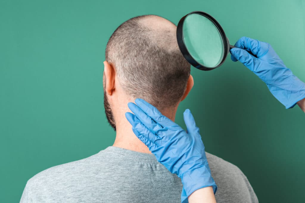 Dottore esamina l'area di calvizie sulla testa del peziente con alopecia.