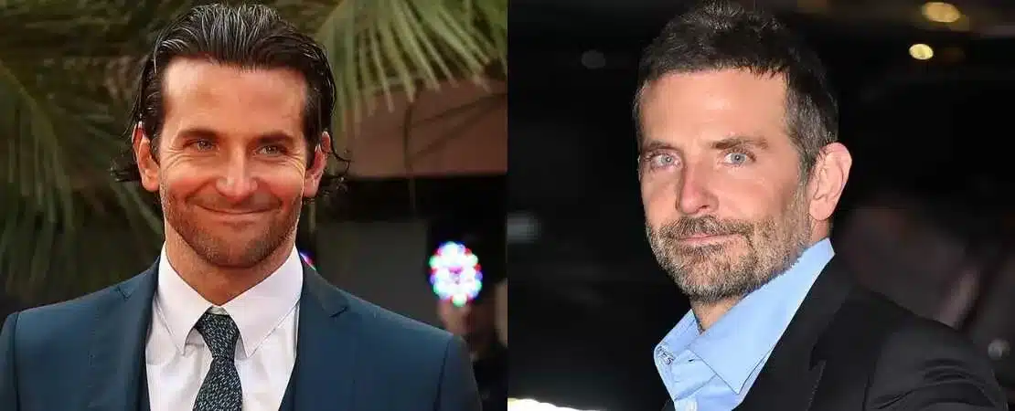 Comparing Bradley Cooper’s hairlines over time suggests possible hair transplant results