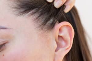 Una joven caucásica que padece dermatitis seborreica.