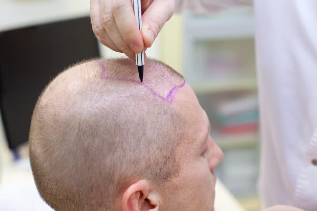 Paziente affetto da calvizie in consultazione con un medico. Preparazione all'intervento di trapianto di capelli. La linea che segna la crescita dei capelli.