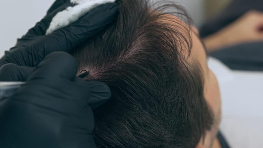Primo piano di un uomo sdraiato su un lettino durante il trattamento estetico dei capelli con la tecnica di tricopigmentazione
