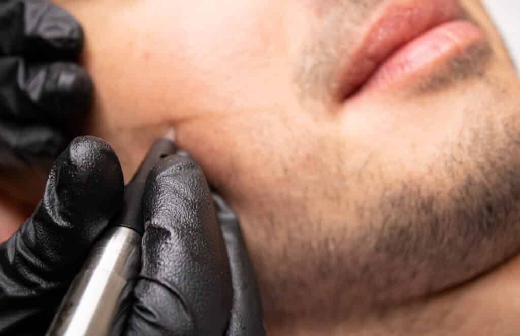 Servizio di tricopigmentazione sul viso di un uomo