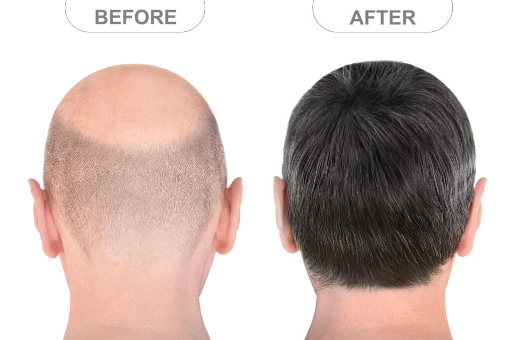 Vista posterior de la cabeza masculina antes y después del pelo